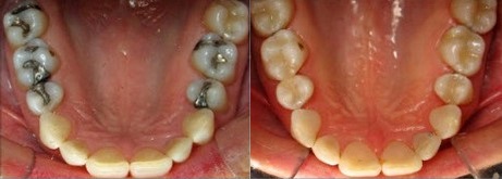 Dental Fillings before and after