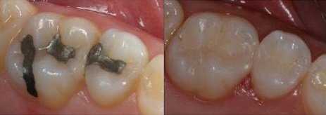 Dental Fillings before and after